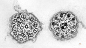 F,7y. | immotile cilia syndrome - nasal mucosa F,7y. | immotile cilia syndrome - nasal mucosa